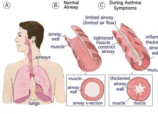 Asthma