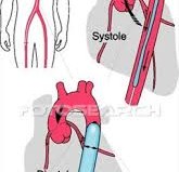 Intra-aortic Balloon