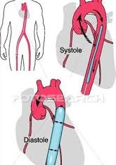 Intra-aortic Balloon