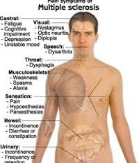 Multiple Sclerosis
