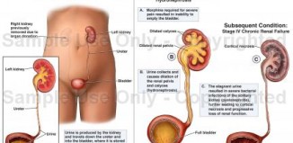 Acute Kidney Failure