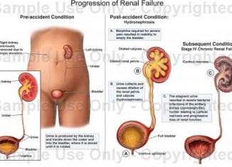 Acute Kidney Failure