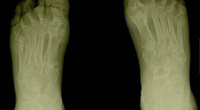 Rheumatoid arthritis