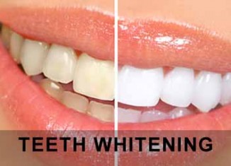 How to Whiten Teeth at Home