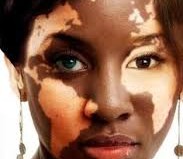 Vitiligo