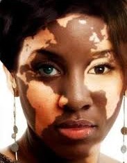 Vitiligo