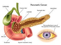 pancreatic-cancer