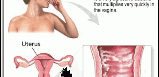 Bacterial Vaginosis