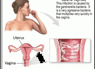 Bacterial Vaginosis