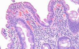 Celiac Disease