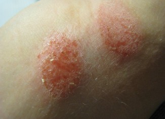 Eczema