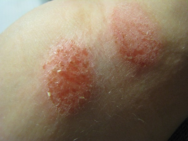 Eczema 