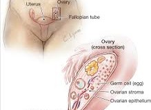 Ovarian Cancer