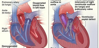 Tetralogy of Fallot