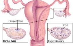 Polycystic ovary syndrome