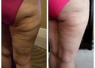 Smoothing Cellulite