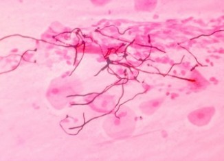 Candida yeast infection