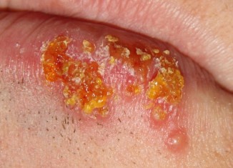 herpes simplex