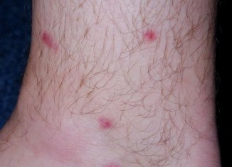 Yeast Infections of the Skin