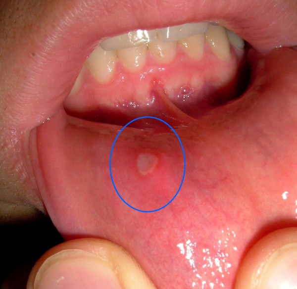 cold sores