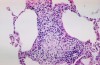 Home remedies & few other medications for treating Sarcoidosis