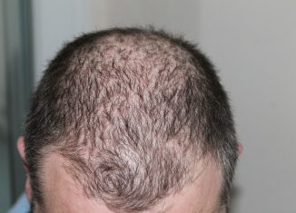 JAK Inhibitors Drugs Restores Hair Growth in Patchy Hair Loss