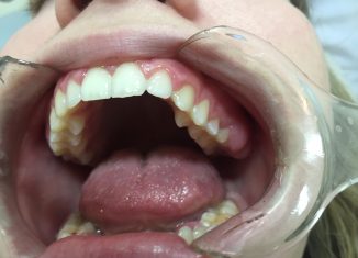 Asthma can be Diagnosed By A Simple Asthma Saliva Test