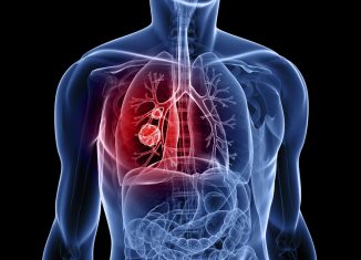 PD-1 Protein Marker Can Predict Lung Cancer Survival