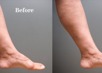 Easy Yet Proven Methods To Treat Varicose Veins