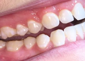 Teeth Enamel Created by Scientists Can Regenerate Easily