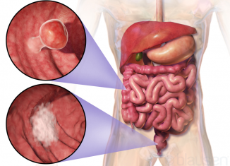 Early Colorectal Cancer Screening Can Benefit Overall Health