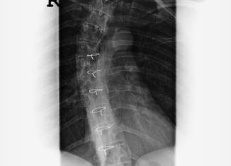 spinal disc herniation