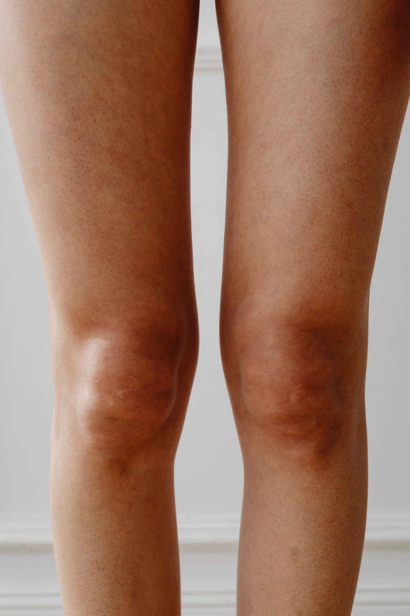 The Best Exercises to Correct Knock Knees